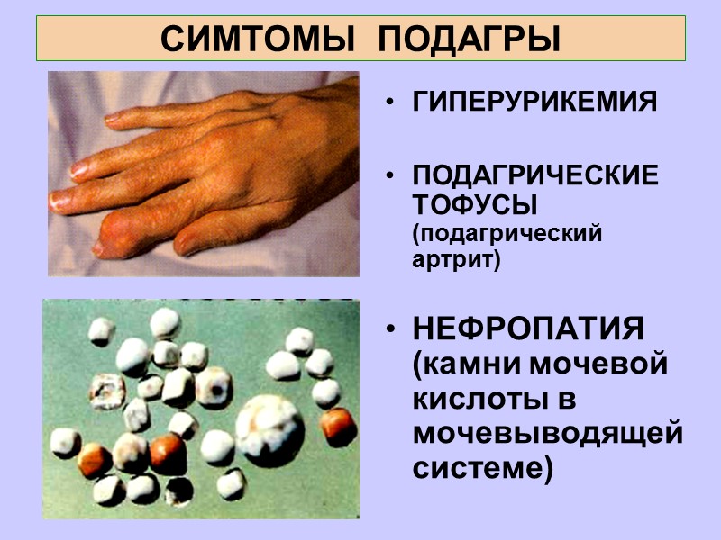 СИМТОМЫ  ПОДАГРЫ ГИПЕРУРИКЕМИЯ  ПОДАГРИЧЕСКИЕ  ТОФУСЫ (подагрический артрит)  НЕФРОПАТИЯ (камни мочевой